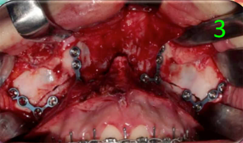Fig 10. Impactación del maxilar 1,2,3,