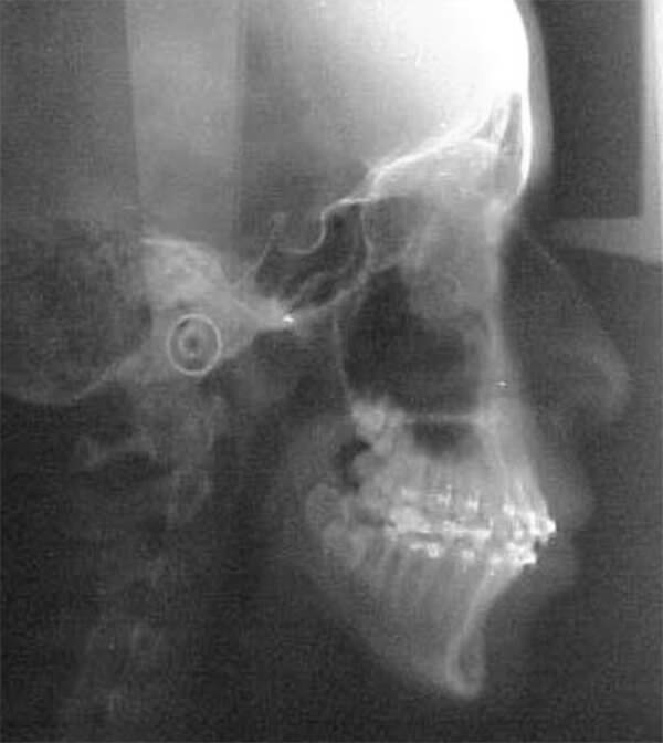 Fig. 9 radiografía lateral de cráneo