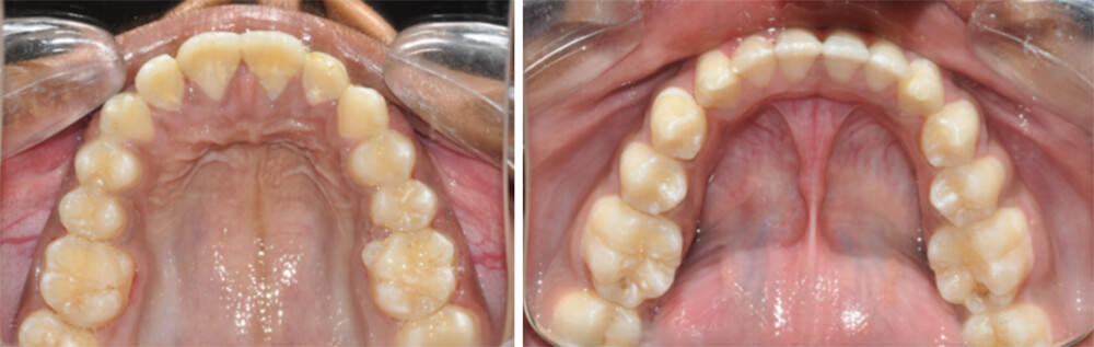 Fig.23 Post treatment Intra oral maxillary occlusal View, Fig.24 Post treatment Intra oral mandibular occlusal View