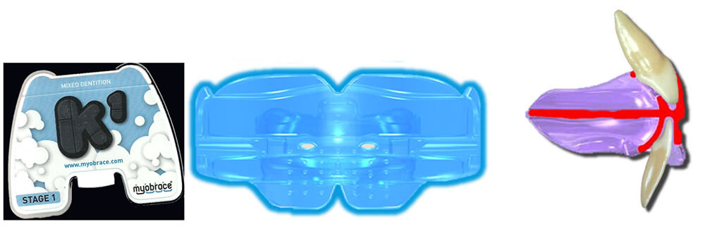 Fig.3 Myobrace K1