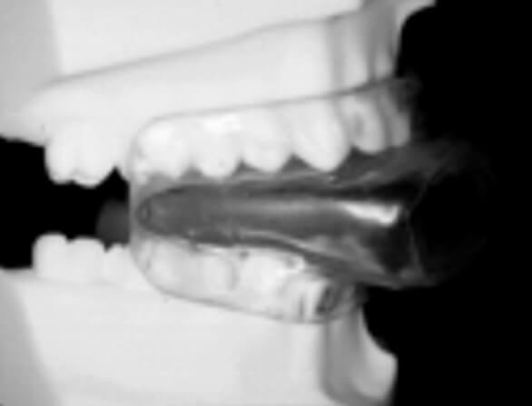 Figura 2. Dispositivo retenedor de lengua diseñado por odontólogos para el tratamiento del Saos