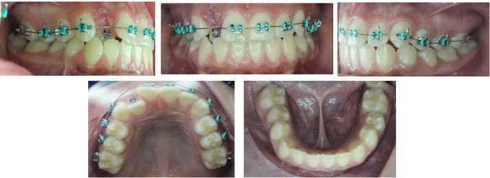 Figura 4. Colocación de brackets en dientes del maxilar