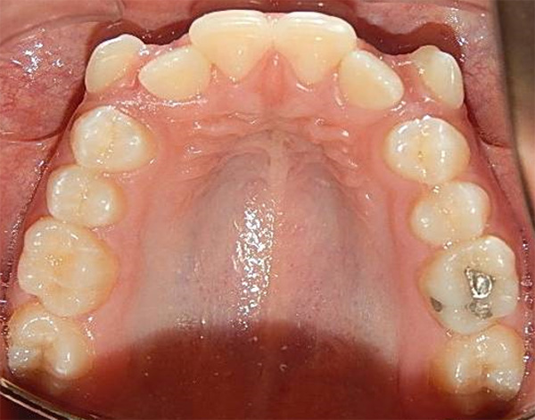 Fig.5 oclusal superior