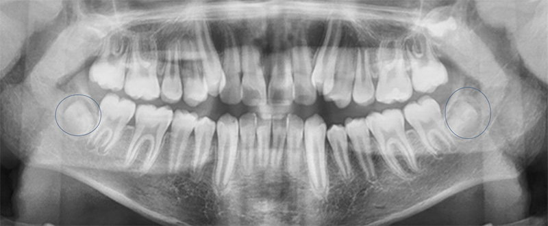 Fig 6. Radiografía Panorámica