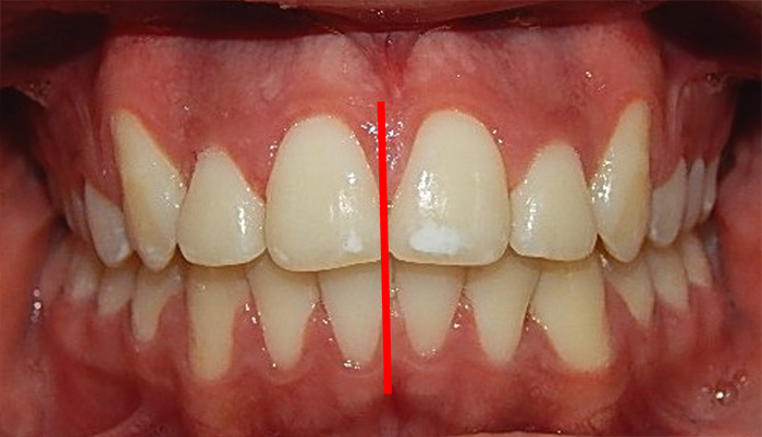 Fig. 12 de frente final