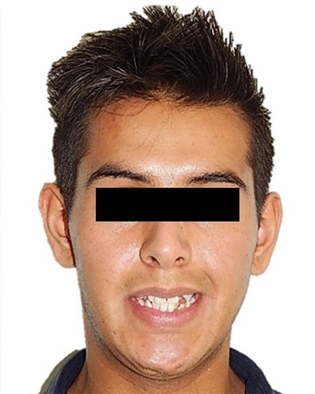 Fig. 2 fotografía de sonrisa