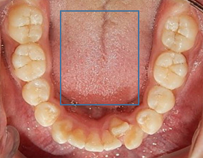 Fig.7 Oclusal inferior