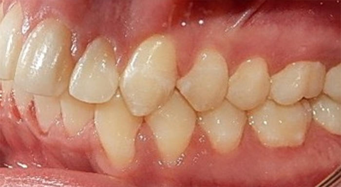 Fig.18 Intraoral izquierda