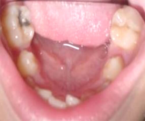 Maxilar inferior apiñado y con falta de espacio