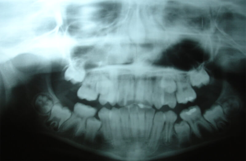 Radiografía panorámica inicial
