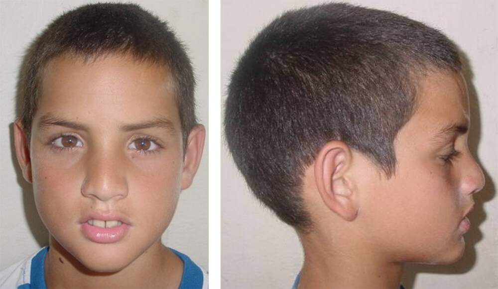 Foto de frente a los 45 días de tratamiento / Perfil mejorado a los 45 días de tratamiento