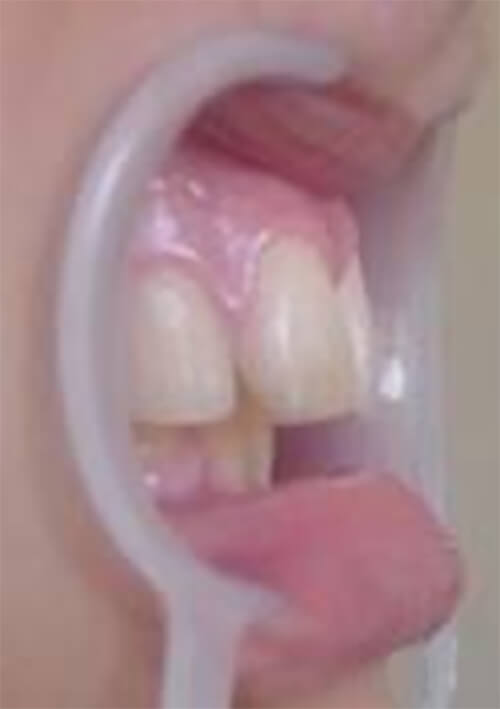 Resalte Incisal disminuido