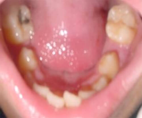 Maxilar inferior ensanchado