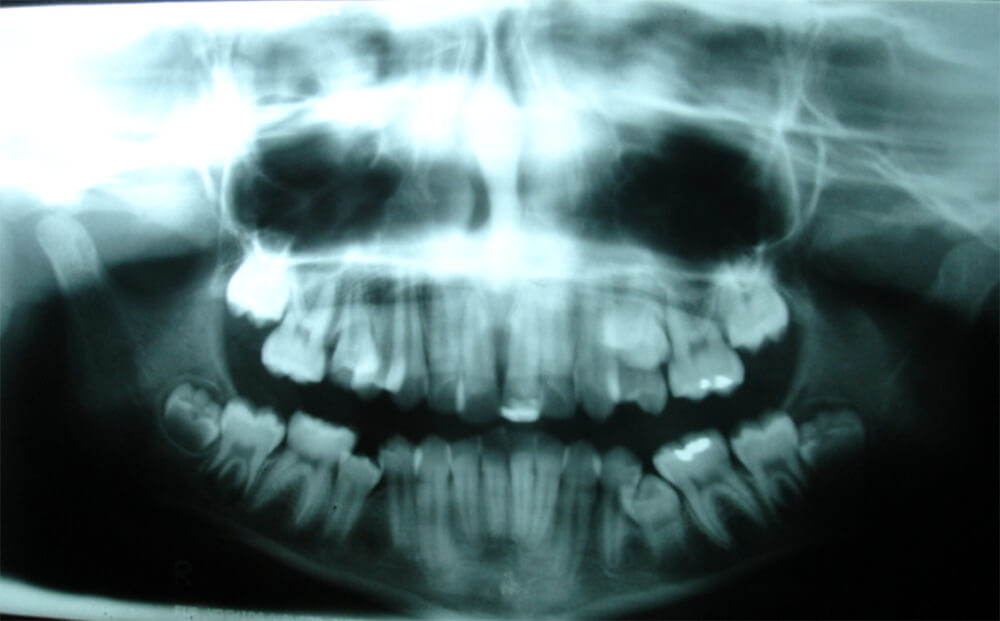 En la radiografía panorámica final