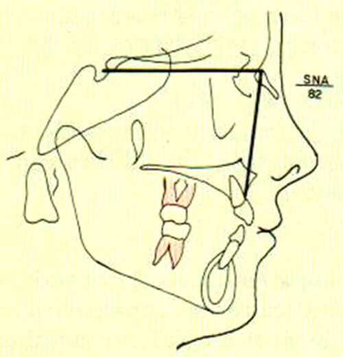 Figura 1. Representación esquemática del ángulo SNA del análisis de Steiner. Tomado del Manual de ortopedia funcional de los maxilares y ortodoncia interceptiva, Quirós, O 1993. (5)