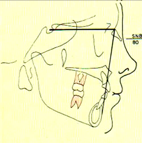Figura 2. Representación esquemática del ángulo SNB del análisis de Steiner. Tomado del Manual de ortopedia funcional de los maxilares y ortodoncia interceptiva, Quirós, O 1993. (5)