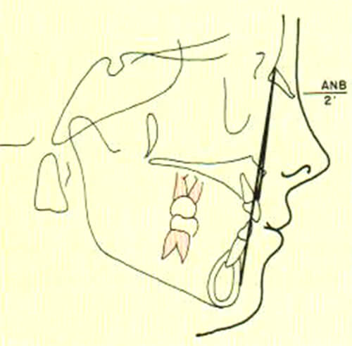 Figura 3. Representación esquemática del ángulo ANB del análisis de Steiner. Tomado del Manual de ortopedia funcional de los maxilares y ortodoncia interceptiva, Quirós, Oscar 1993. (5)