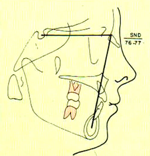 Figura 4. Representación esquemática del ángulo SND del análisis de Steiner. Tomado del Manual de ortopedia funcional de los maxilares y ortodoncia interceptiva, Quirós, O. 1993. (5)