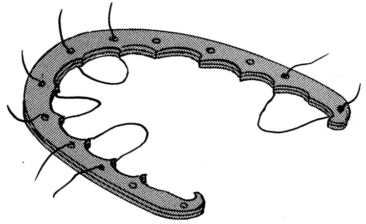 Figura 1 Arco de expansión de Fauchard