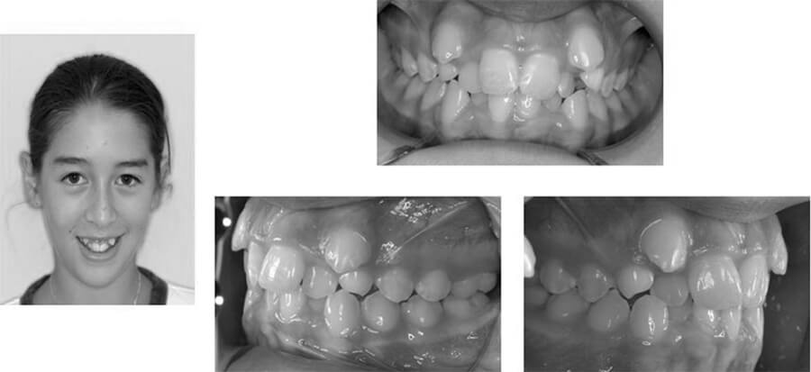 Pre-treatment