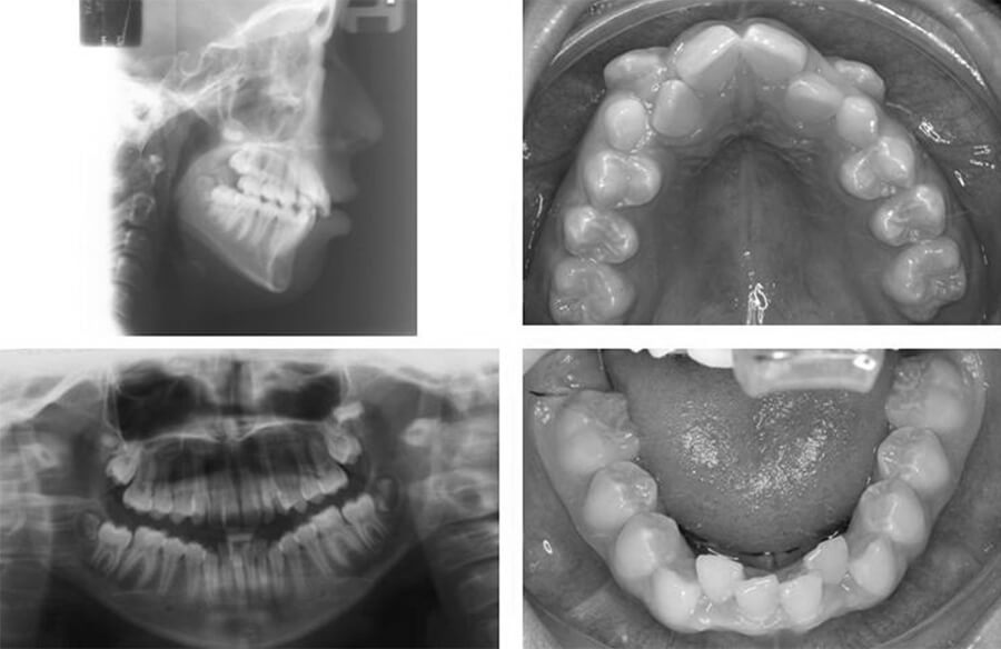 Pre-treatment