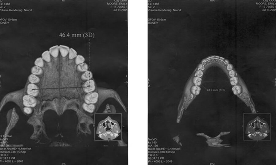 CT Scans - Upper / Lower