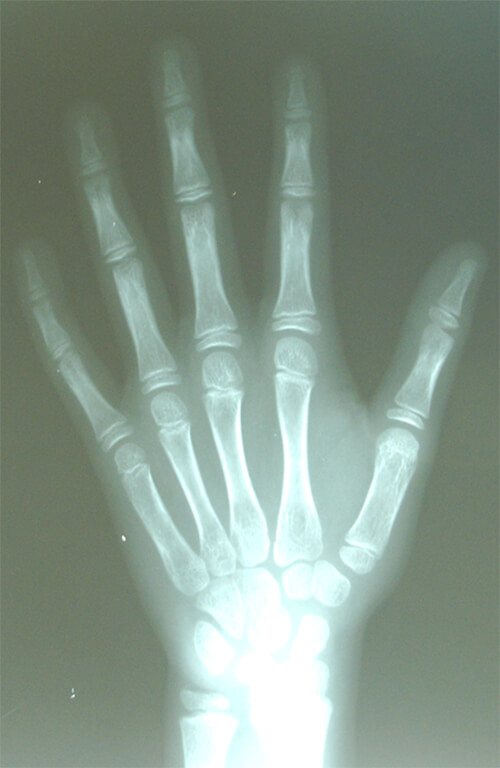 Fig 1. RADIOGRAFIA CARPAL