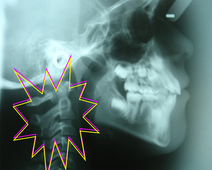 Fig 4. RADIOGRAFIA CEFALICA LATERAL