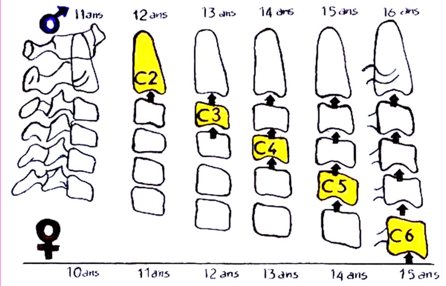 Fig 5. EDAD CERVICAL SEGÚN LAMPARSKI EN CUANTO A SEXO