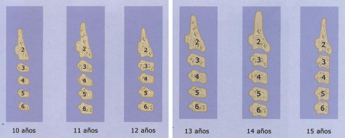 Fig 6. RESUMEN DEL PROCESO DE MADURACION DE LAS VERTEBRAS CERVICALES POR EDAD Fuente: D´ Escriban L. Ortodoncia en dentición mixta. Caracas. Amolca. 2007.
