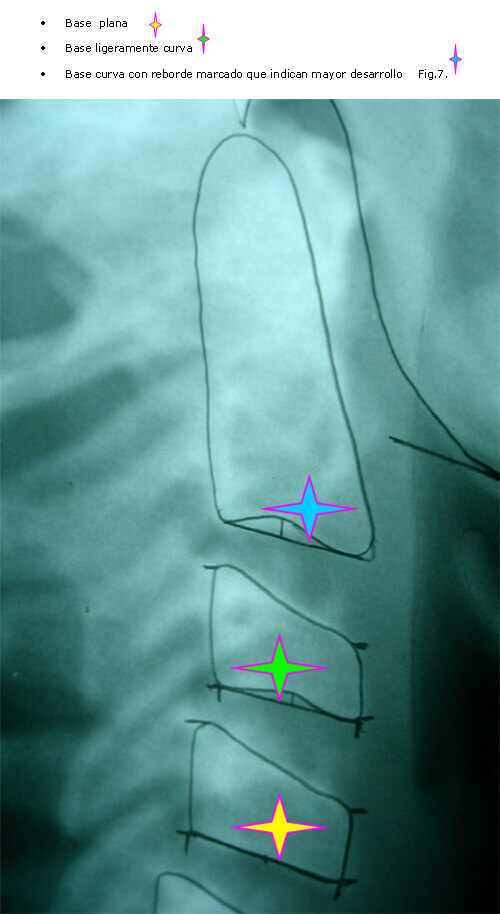 Fig 7. CLASIFICACION DEL BORDE INFERIOR DE LA CONCAVIDAD SEGÚN MOSCOSO Y COLS