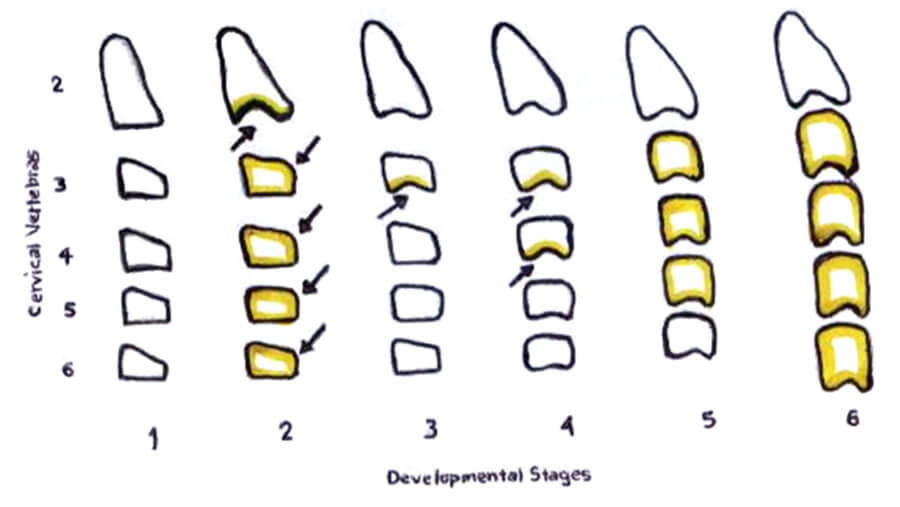 Fig 8. ESTADO DE MADURACIÓN DE LAS VERTEBRAS CERVICALES SEGÚN O`Reilly