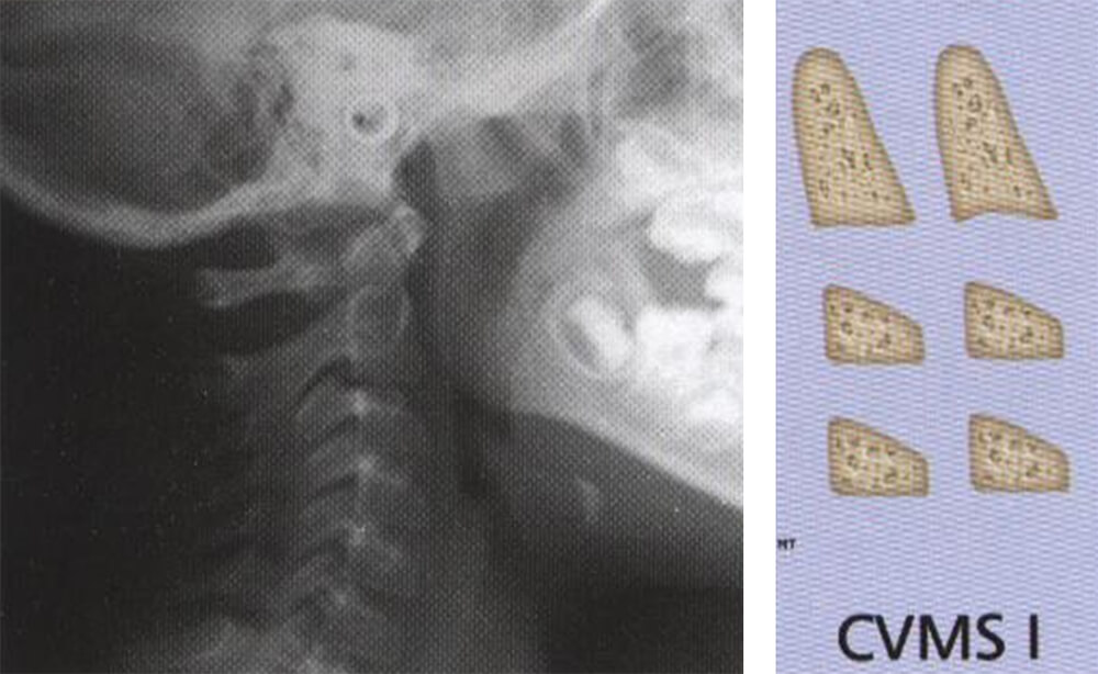 Fig 11. IMAGEN DEL ESTADIO I. ASPECTO RADIOGRAFICO Y ESQUEMA Fuente: D´ Escriban L. Ortodoncia en dentición mixta. Caracas. Amolca. 2007
