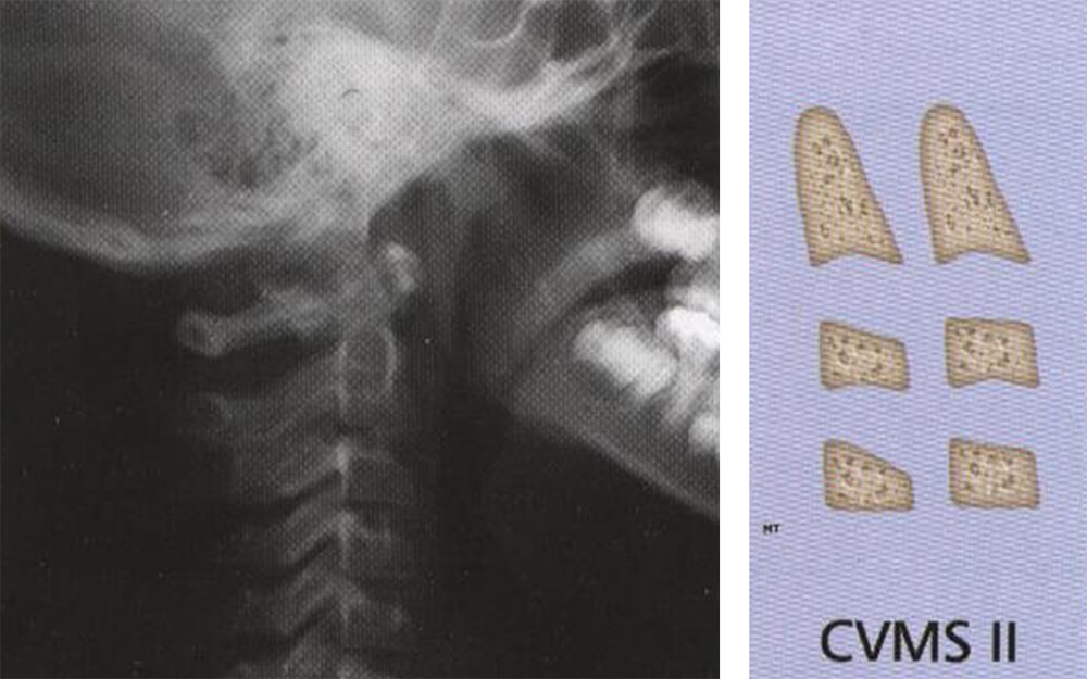Fig 12. IMAGEN DEL ESTADIO II. ASPECTO RADIOGRAFICO Y ESQUEMA Fuente: D´ Escriban L. Ortodoncia en dentición mixta. Caracas. Amolca. 2007