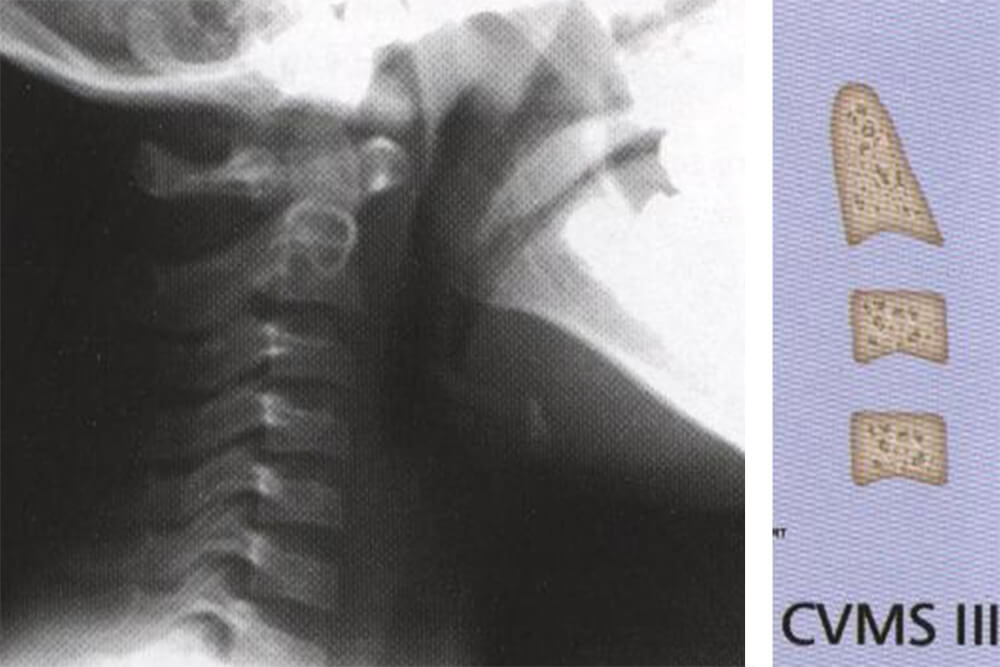 Fig 13. IMAGEN DEL ESTADIO iII. ASPECTO RADIOGRAFICO Y ESQUEMA Fuente: D´ Escriban L. Ortodoncia en dentición mixta. Caracas. Amolca. 2007