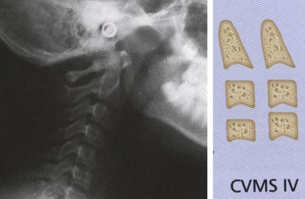 Fig 14. IMAGEN DEL ESTADIO IV. ASPECTO RADIOGRAFICO Y ESQUEMA Fuente: D´ Escriban L. Ortodoncia en dentición mixta. Caracas. Amolca. 2007