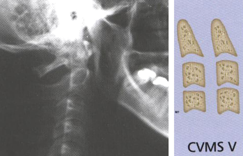 Fig 15. IMAGEN DEL ESTADIO V. ASPECTO RADIOGRAFICO Y ESQUEMA Fuente: D´ Escriban L. Ortodoncia en dentición mixta. Caracas. Amolca. 2007