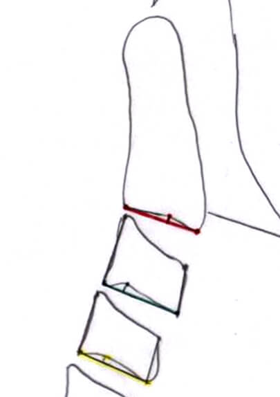 Fig 17. MEDICIÓN DE LA CONCAVIDAD