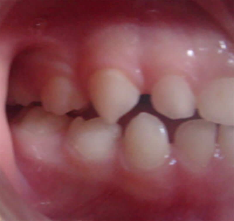 FIGURA 2 Vista intraoral de paciente con espacios primates. Postgrado de Ortodoncia, Facultad de Odontología, U.C.V.