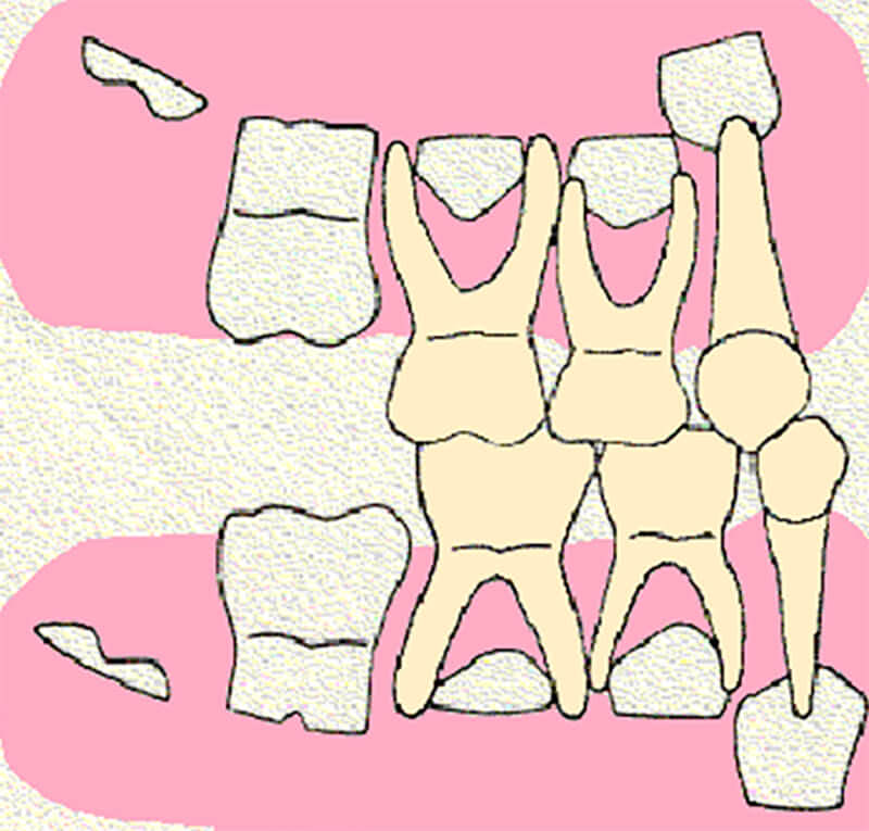 FIGURA 5 Escalón Mesial.