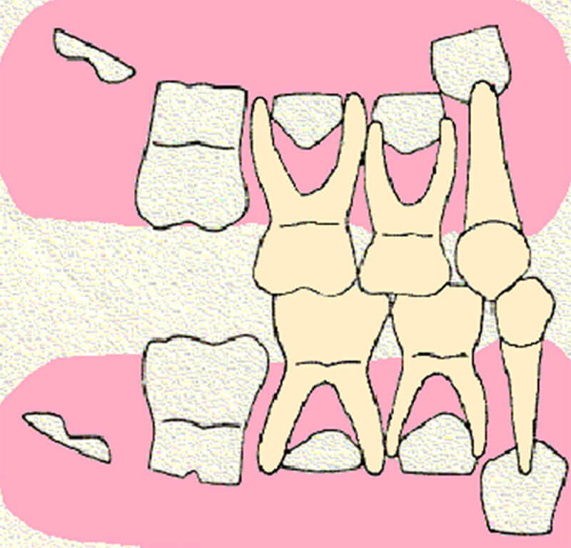 FIGURA 12 Dibujo esquemático de las características radiográficas observadas por Van der Linden con referencia a la zona de premolares y caninos inferiores permanentes de un paciente con patrón de erupción normal.