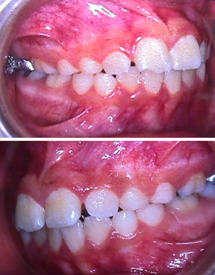 FIGURA 22 Incisivos superiores vestibularizados con diastemas entre 11-12 y 21-22. Relación canina y molar de Clase I.