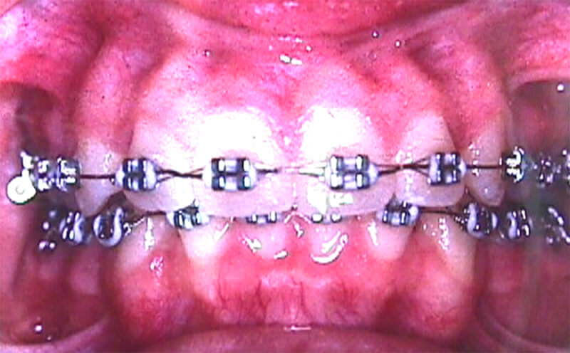 FIGURA 35 Tratamiento ortodóncico.