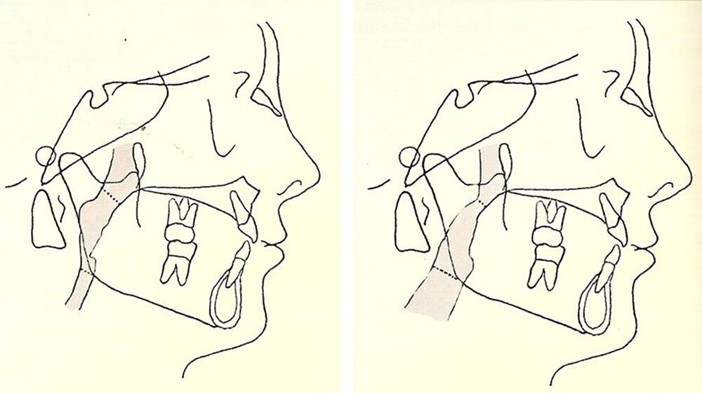 Figura Nº 4 Tomado del libro Bases Biomecánicas y aplicaciones clínicas en Ortodoncia interceptiva.Oscar Quirós A. 2006.1 Relación entre la Función Respiratoria y Morfología Facial