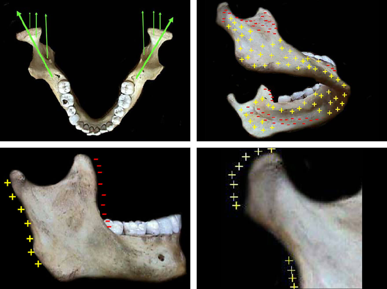 Figuras 2a, 2b, 2c, 2d Crecimiento Mandibular (Fuente: Compendio de Crecimiento y Desarrollo Craneofacial) (10)