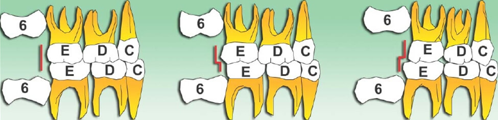 Figura 5 Clasificación de la Oclusión en Dentición Temporal. De izquierda a derecha: Plano Terminal recto, escalón mesial, escalón distal (Fuente: El Desarrollo de la Dentición Humana) (14)