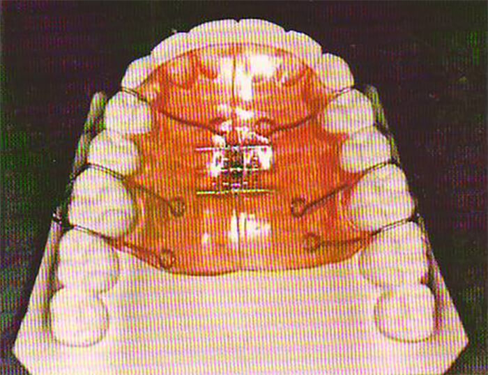 Figura 10a Placa Superior con Expansor Bilateral (Fuente: Bases Biomecánicas y Aplicaciones Clínicas en Ortodoncia Interceptiva)(19)
