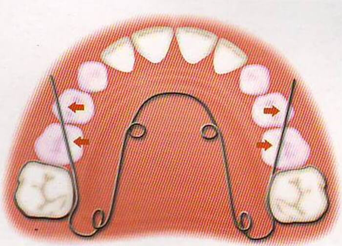 Figura 10b Quad Helix (Fuente: Ortodoncia en Dentición Mixta)(21)