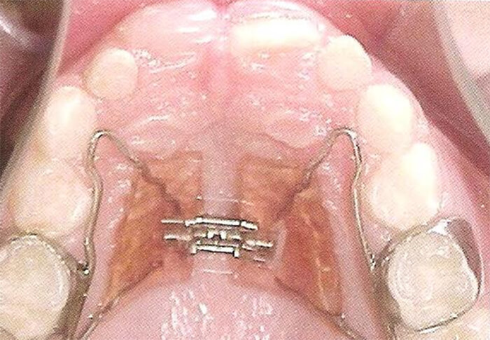 Figura 11b. Haas (Fuente: Ortodoncia en Dentición Mixta21)