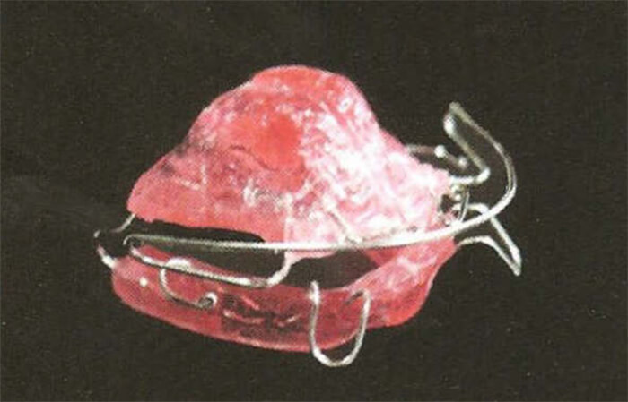 Figura 12b SN1 (Fuente: Bases Biomecánicas y Aplicaciones Clínicas en Ortodoncia Interceptiva)(19)